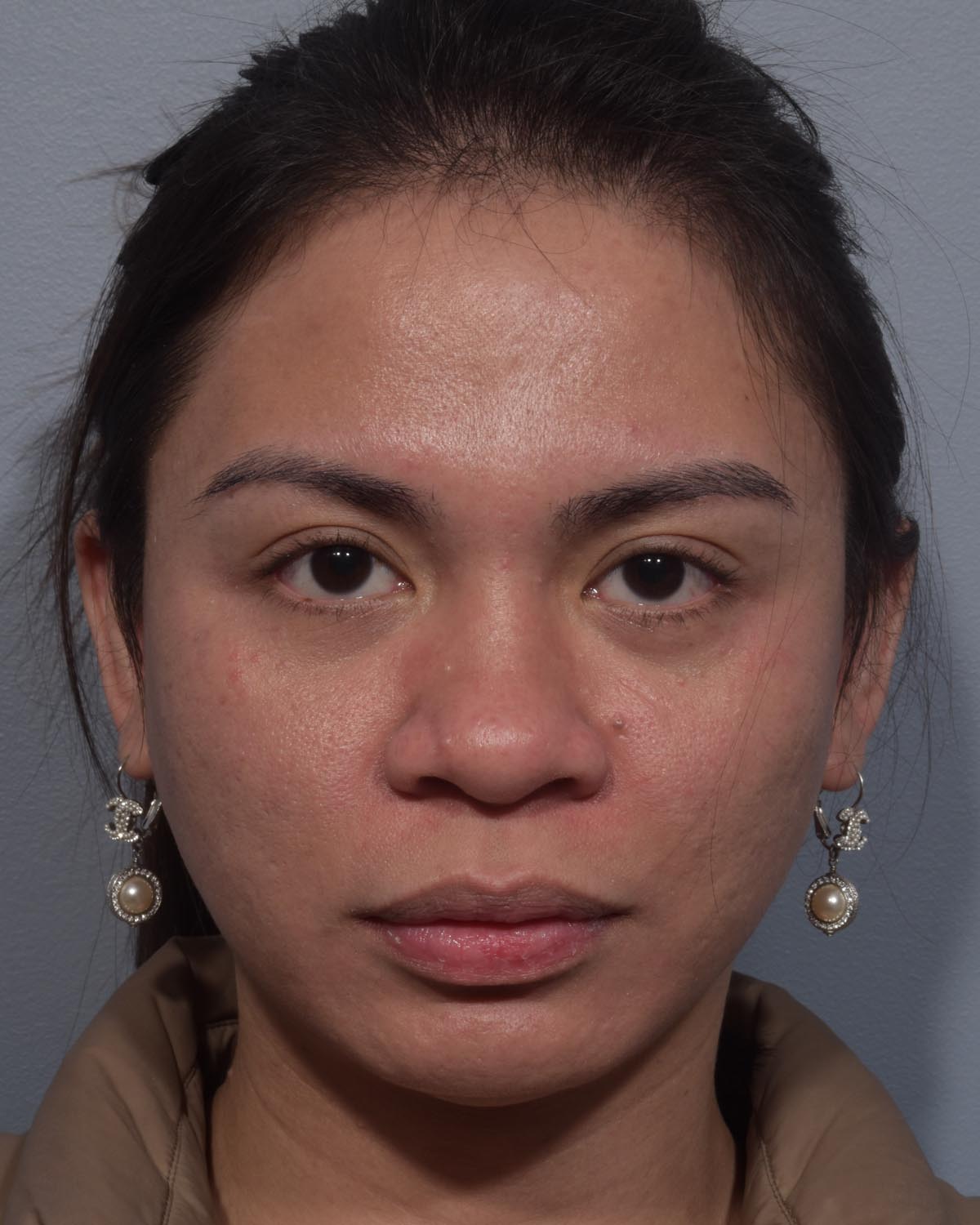 Before Rhinoplasty - Vegas Facial Plastics, Mehdi Sina, MD