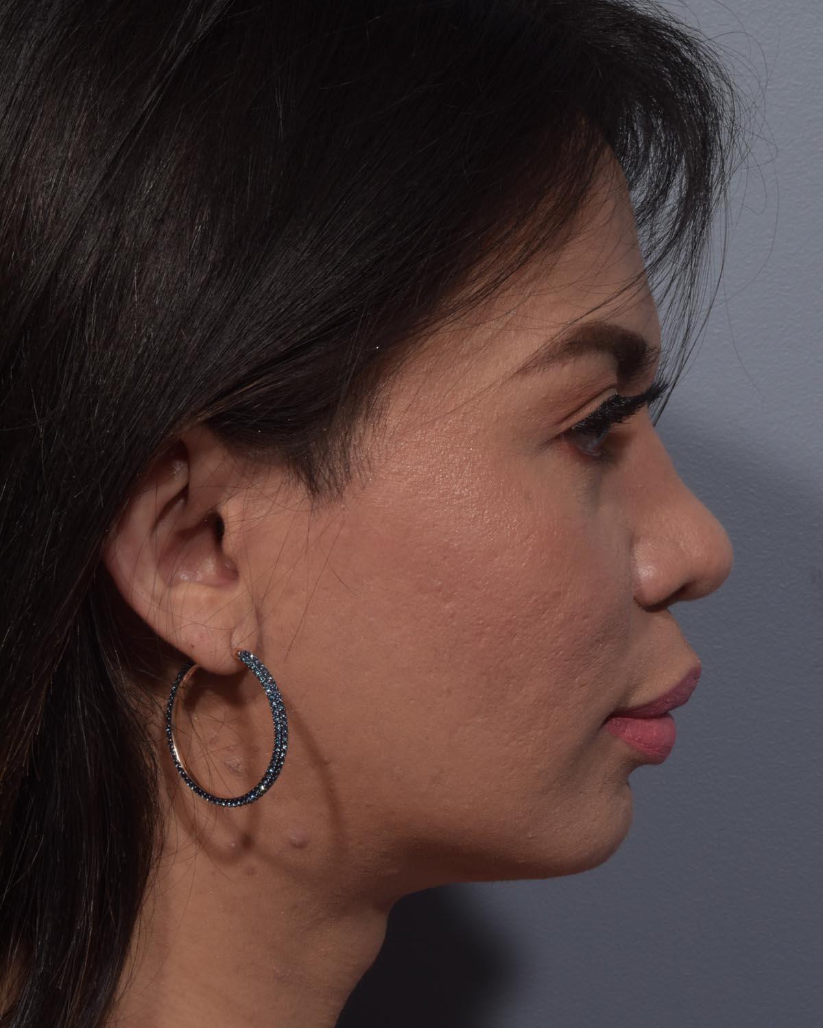 After Rhinoplasty Profile - Vegas Facial Plastics, Mehdi Sina, MD