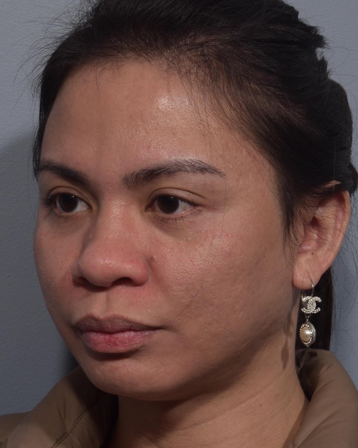 Before Rhinoplasty Oblique - Vegas Facial Plastics, Mehdi Sina, MD