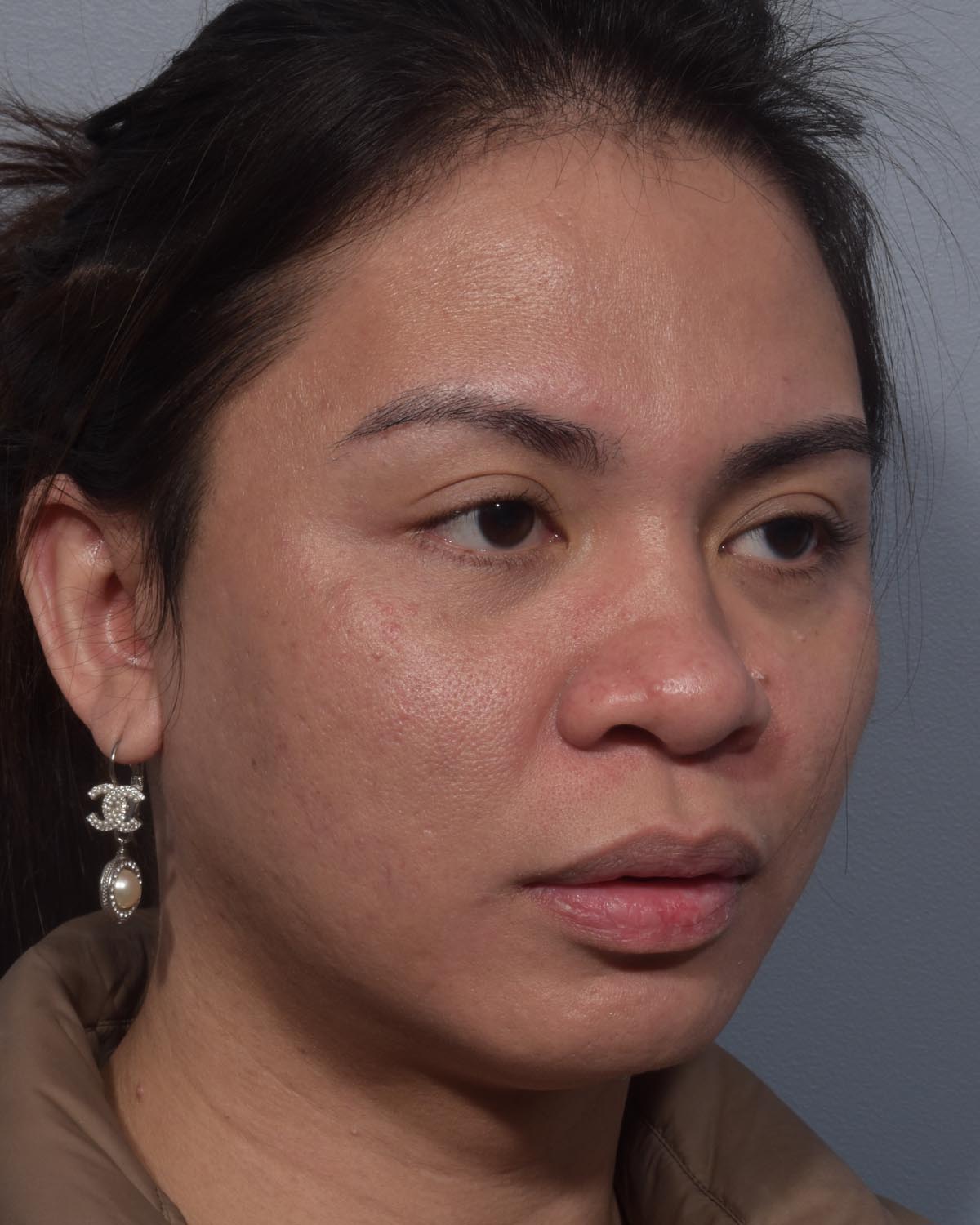 Before Rhinoplasty Oblique - Vegas Facial Plastics, Mehdi Sina, MD