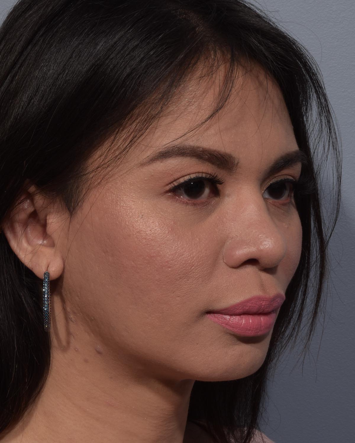 After Rhinoplasty Oblique - Vegas Facial Plastics, Mehdi Sina, MD