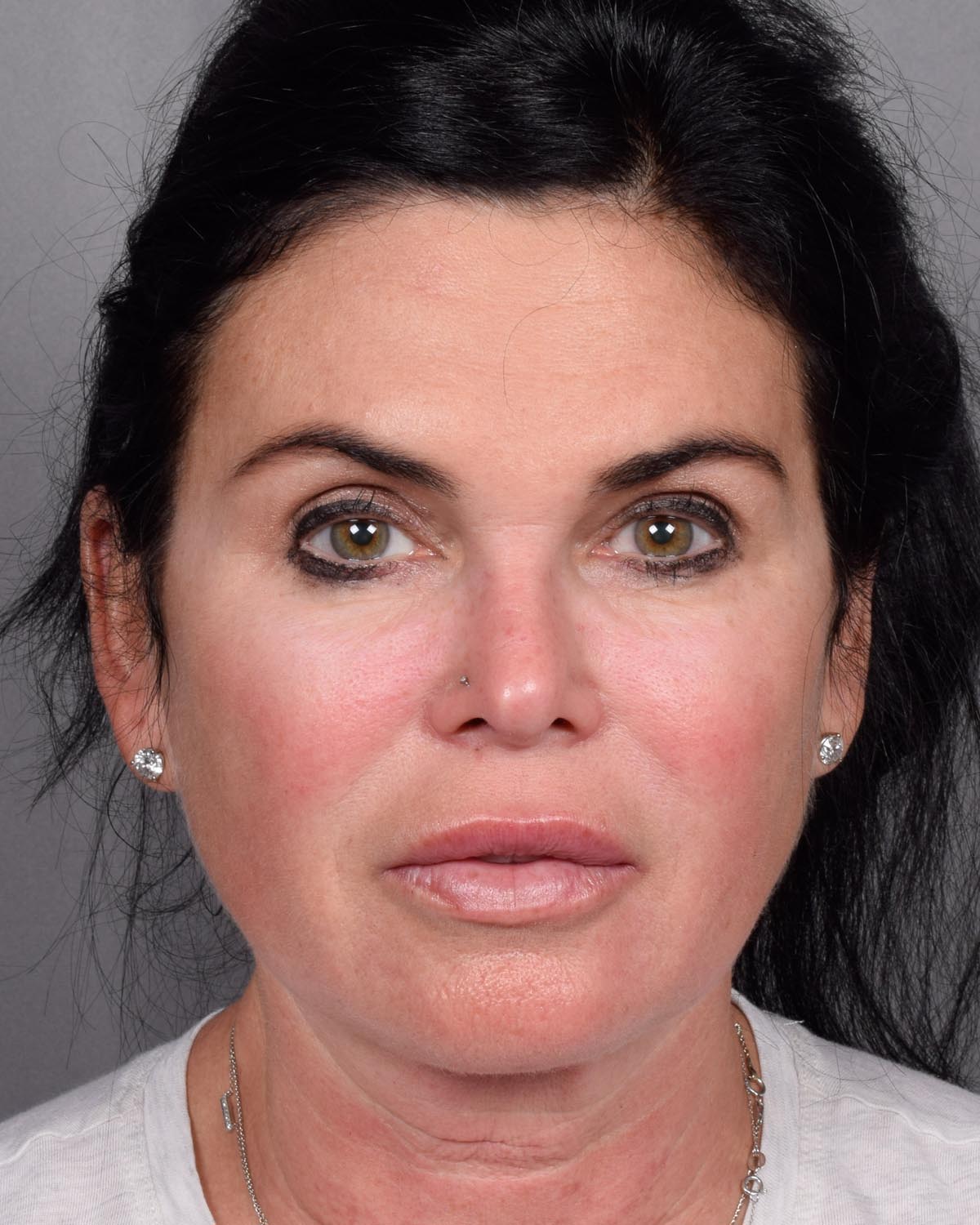 Before Brow Lift - Vegas Facial Plastics, Mehdi Sina, MD