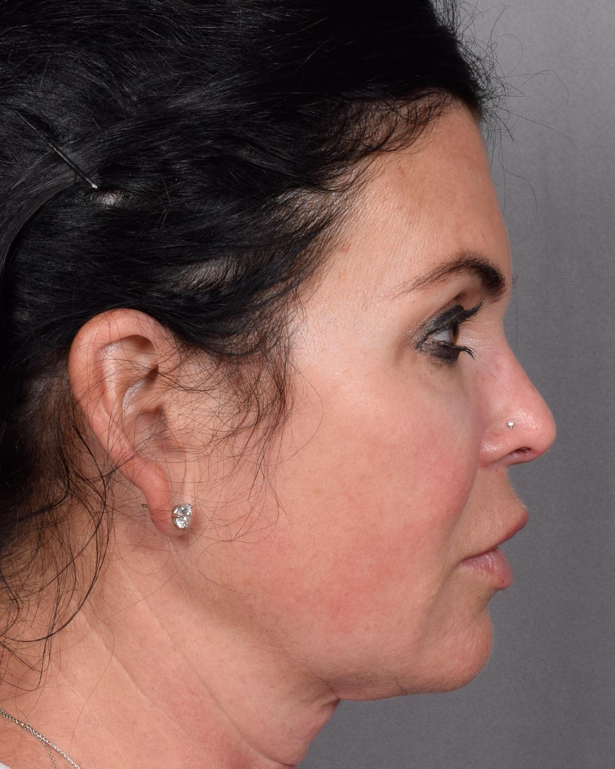 Before Brow Lift Profile - Vegas Facial Plastics, Mehdi Sina, MD