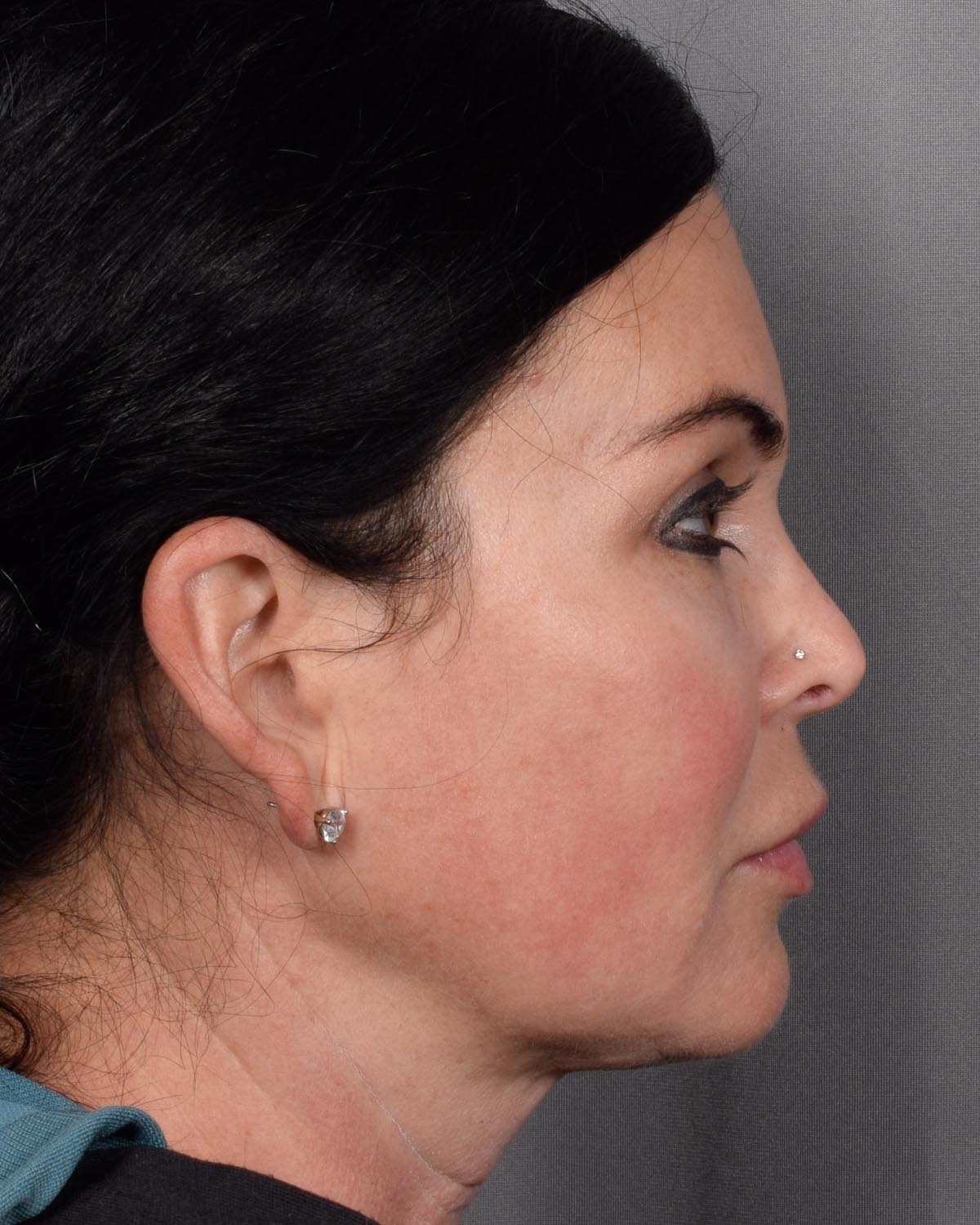 After Brow Lift Profile - Vegas Facial Plastics, Mehdi Sina, MD