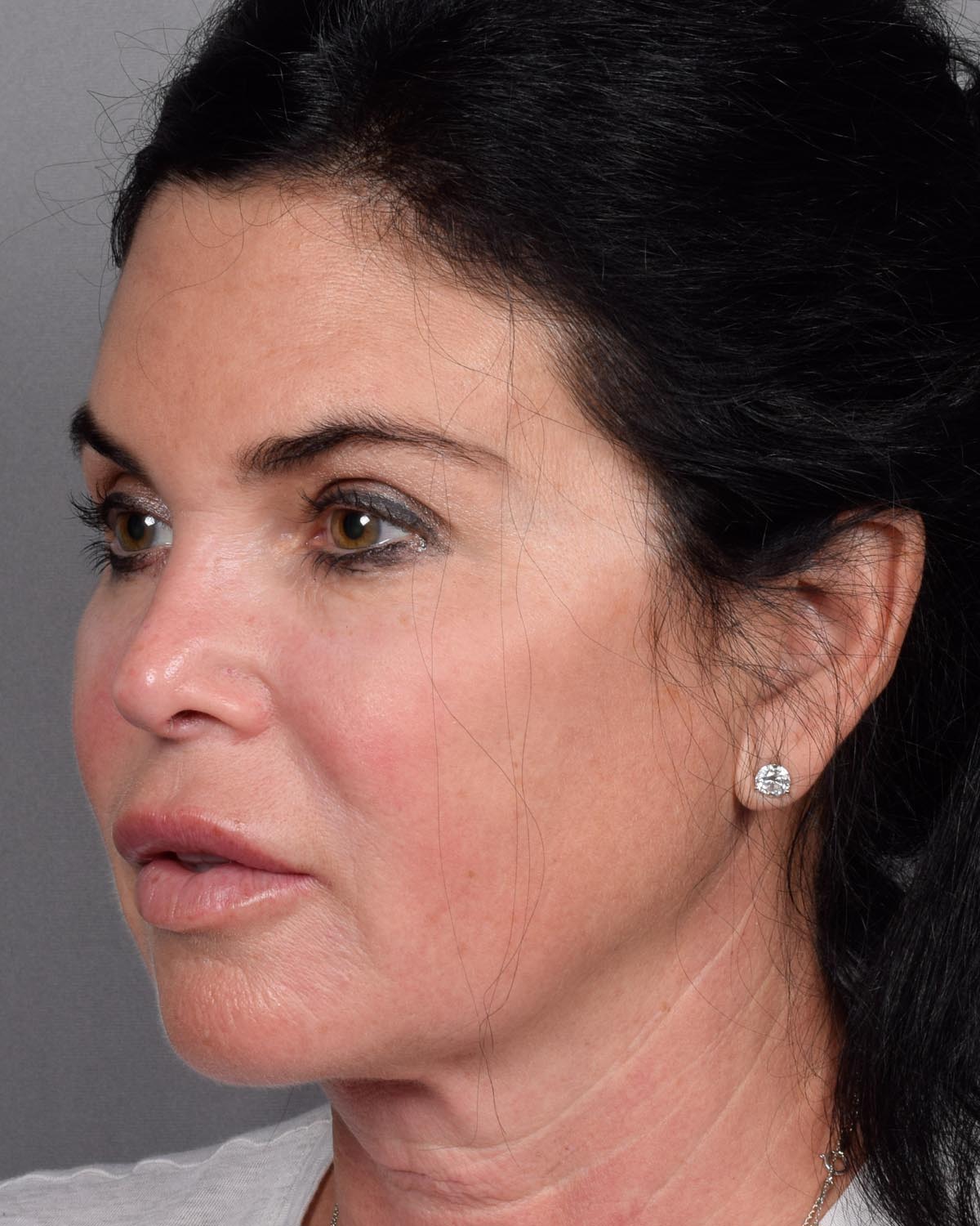 Before Brow Lift Oblique - Vegas Facial Plastics, Mehdi Sina, MD