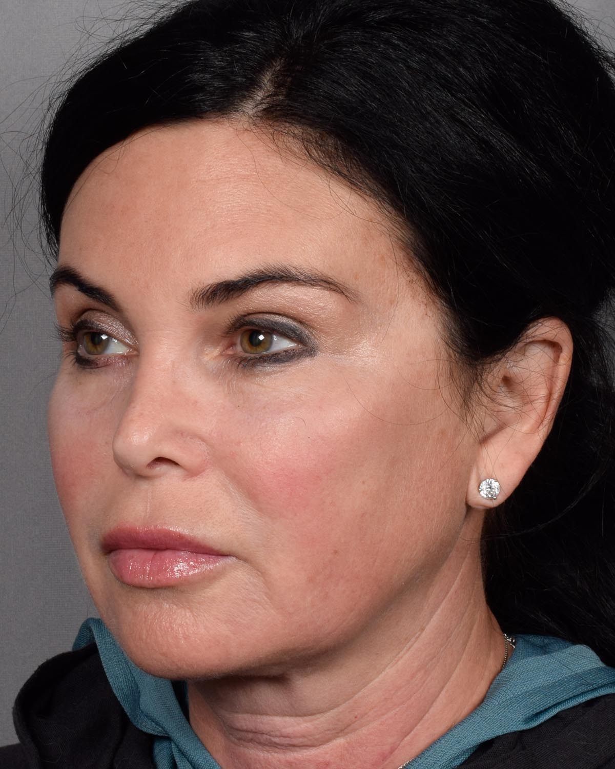 After Brow Lift Oblique - Vegas Facial Plastics, Mehdi Sina, MD