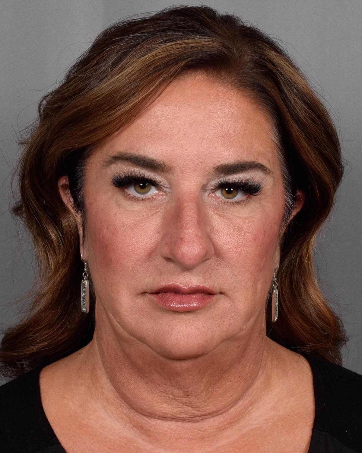 Before Blepharoplasty, facelift and neck lift, full face Laser resurfacing with CO2