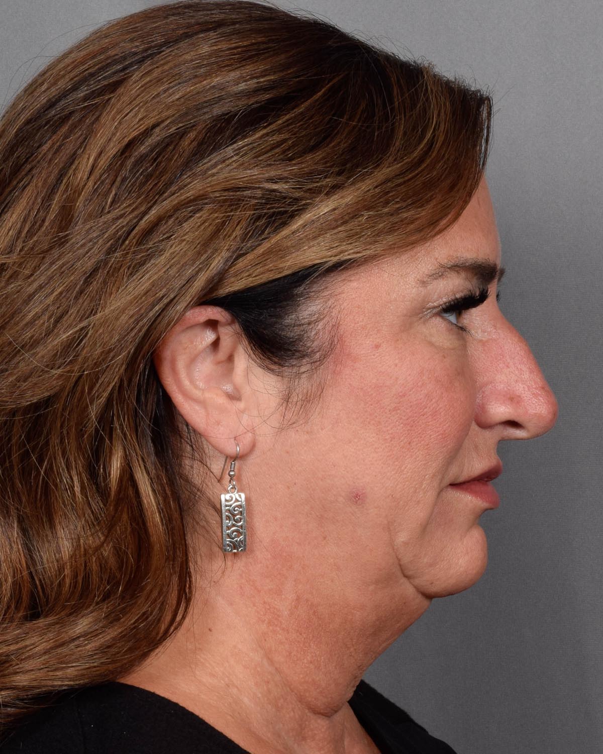 Before Blepharoplasty, facelift and neck lift, full face Laser resurfacing with CO2 in profile