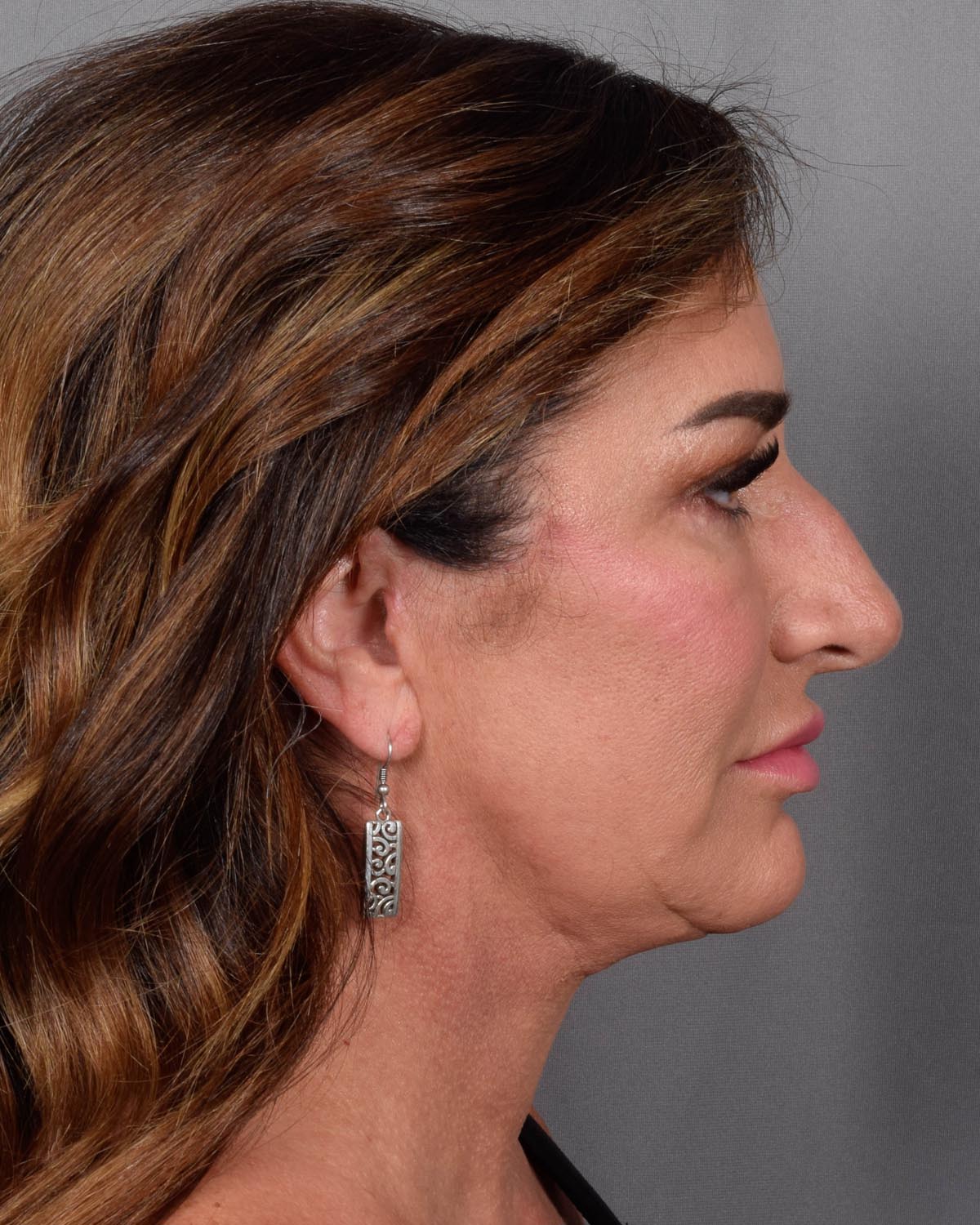 After Blepharoplasty, facelift and neck lift, full face Laser resurfacing with CO2 in profile