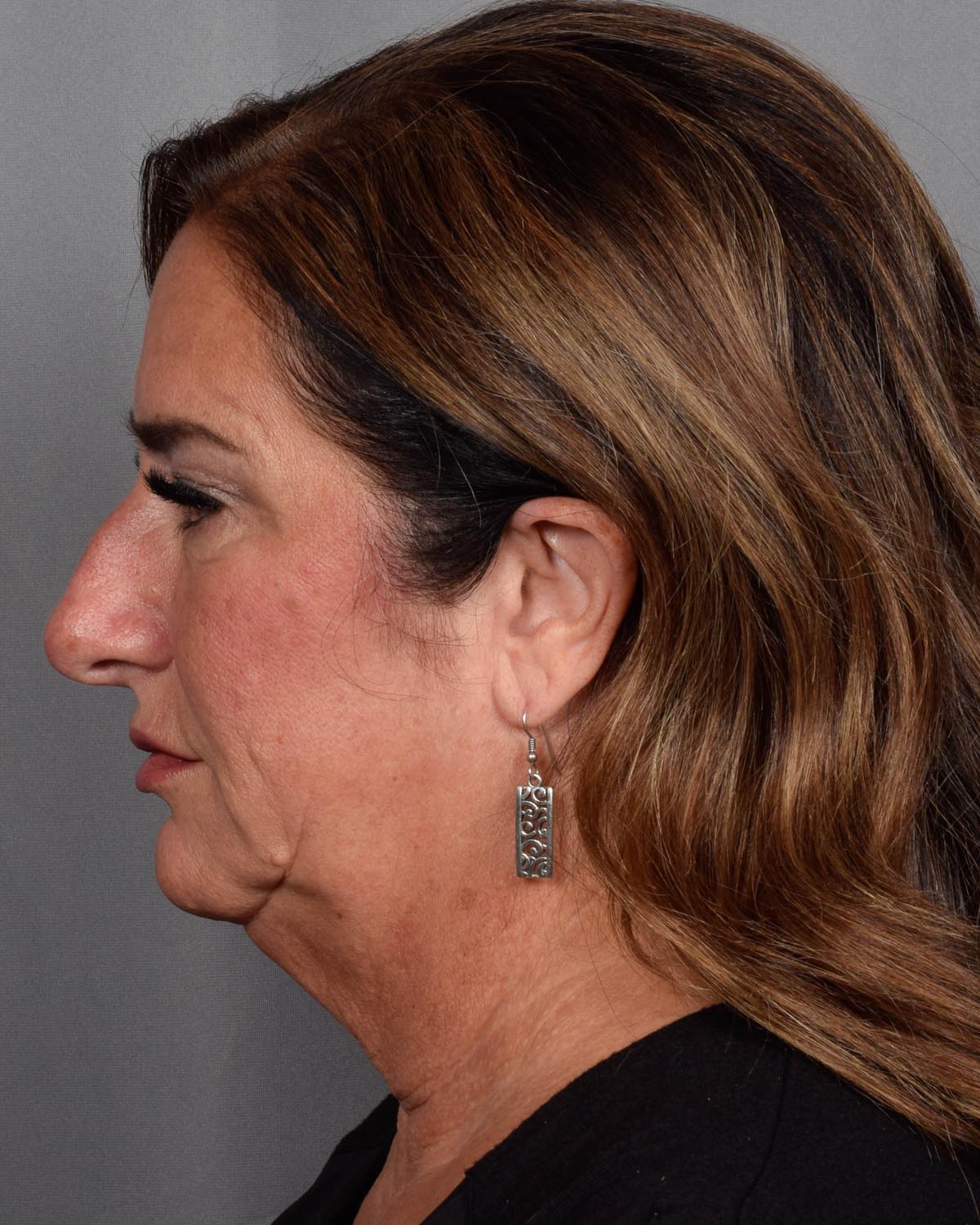 Before Blepharoplasty, facelift and neck lift, full face Laser resurfacing with CO2 in profile