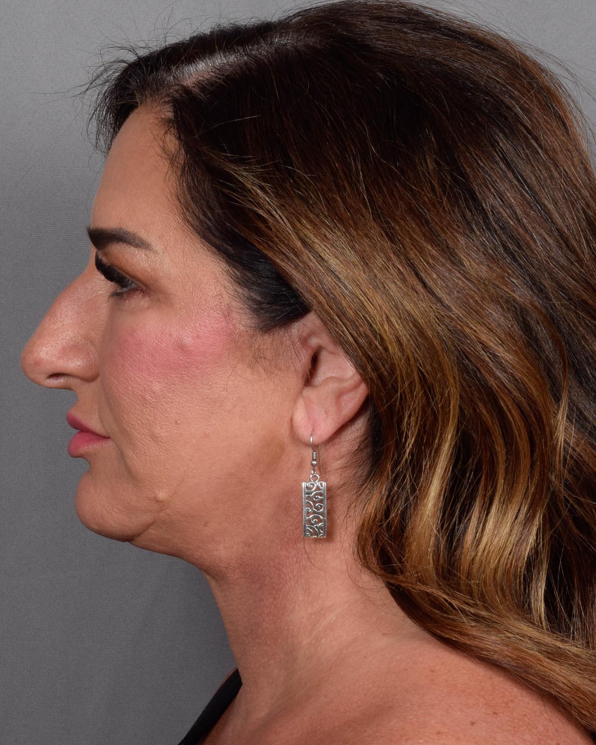 After Blepharoplasty, facelift and neck lift, full face Laser resurfacing with CO2 in profile