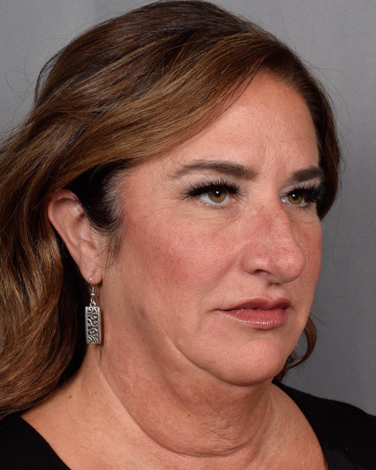 Before Blepharoplasty, facelift and neck lift, full face Laser resurfacing with CO2 Oblique View