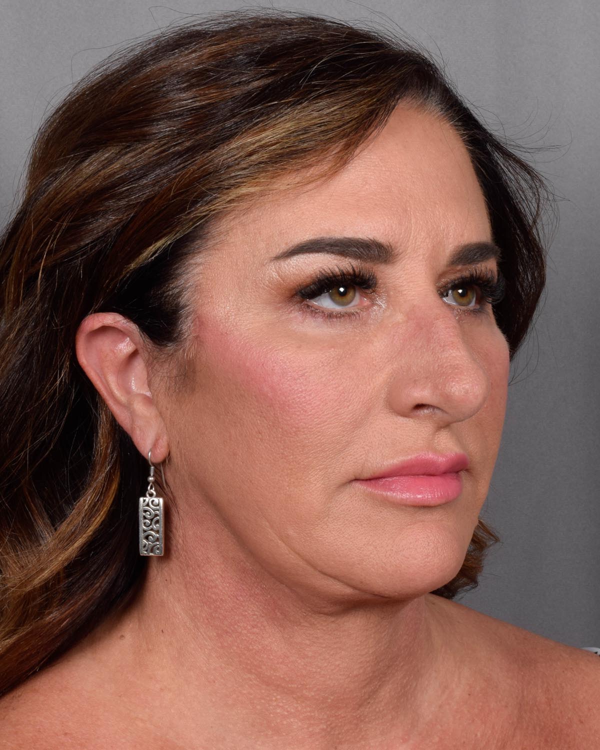 After Blepharoplasty, facelift and neck lift, full face Laser resurfacing with CO2 Oblique View