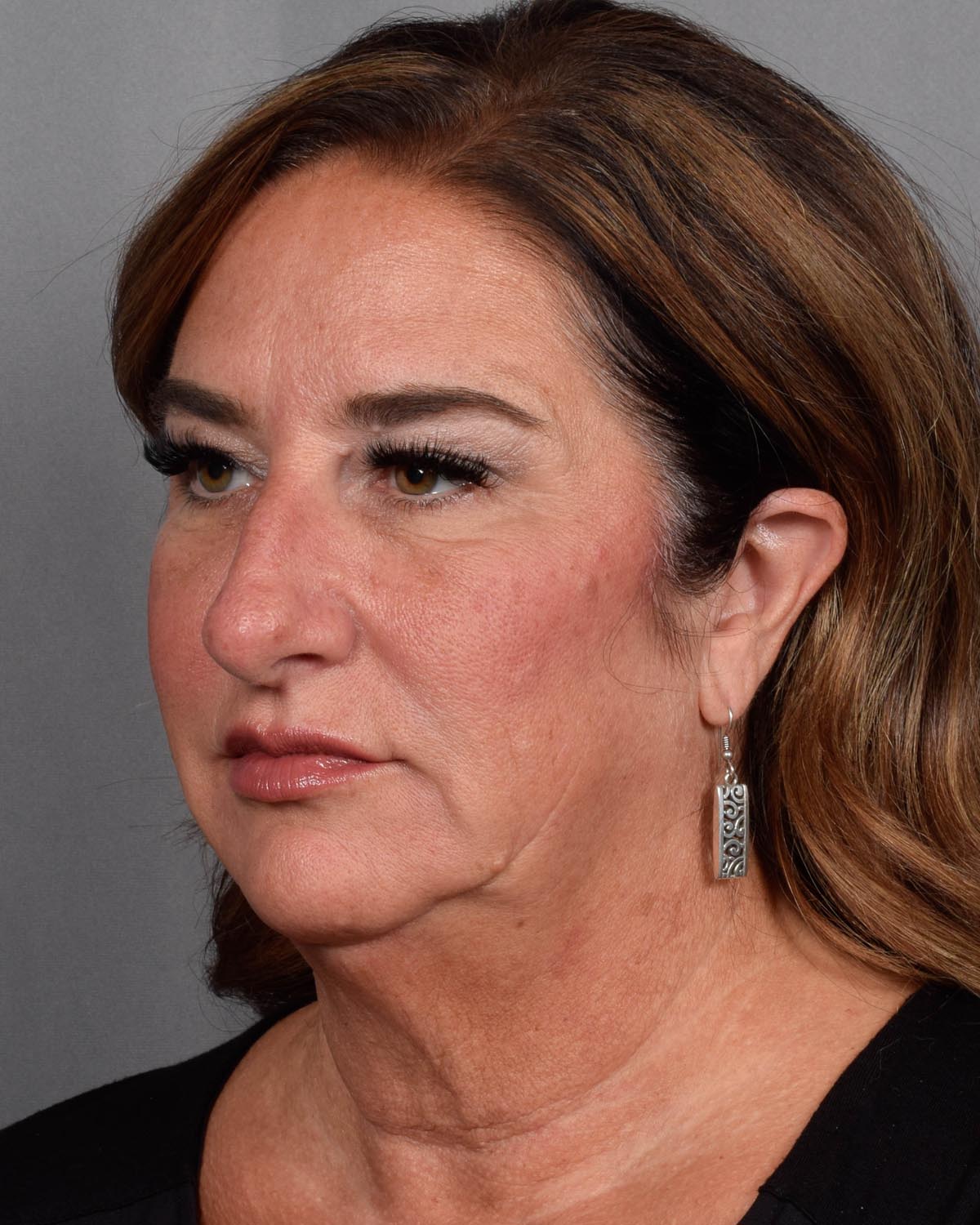 Before Blepharoplasty, facelift and neck lift, full face Laser resurfacing with CO2 Oblique View