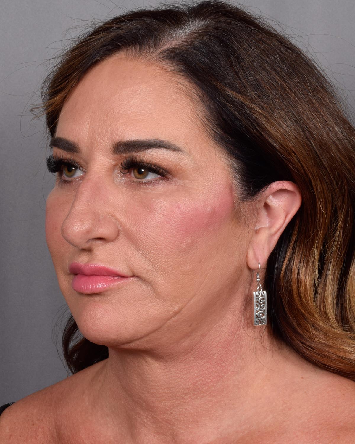 After Blepharoplasty, facelift and neck lift, full face Laser resurfacing with CO2 Oblique View