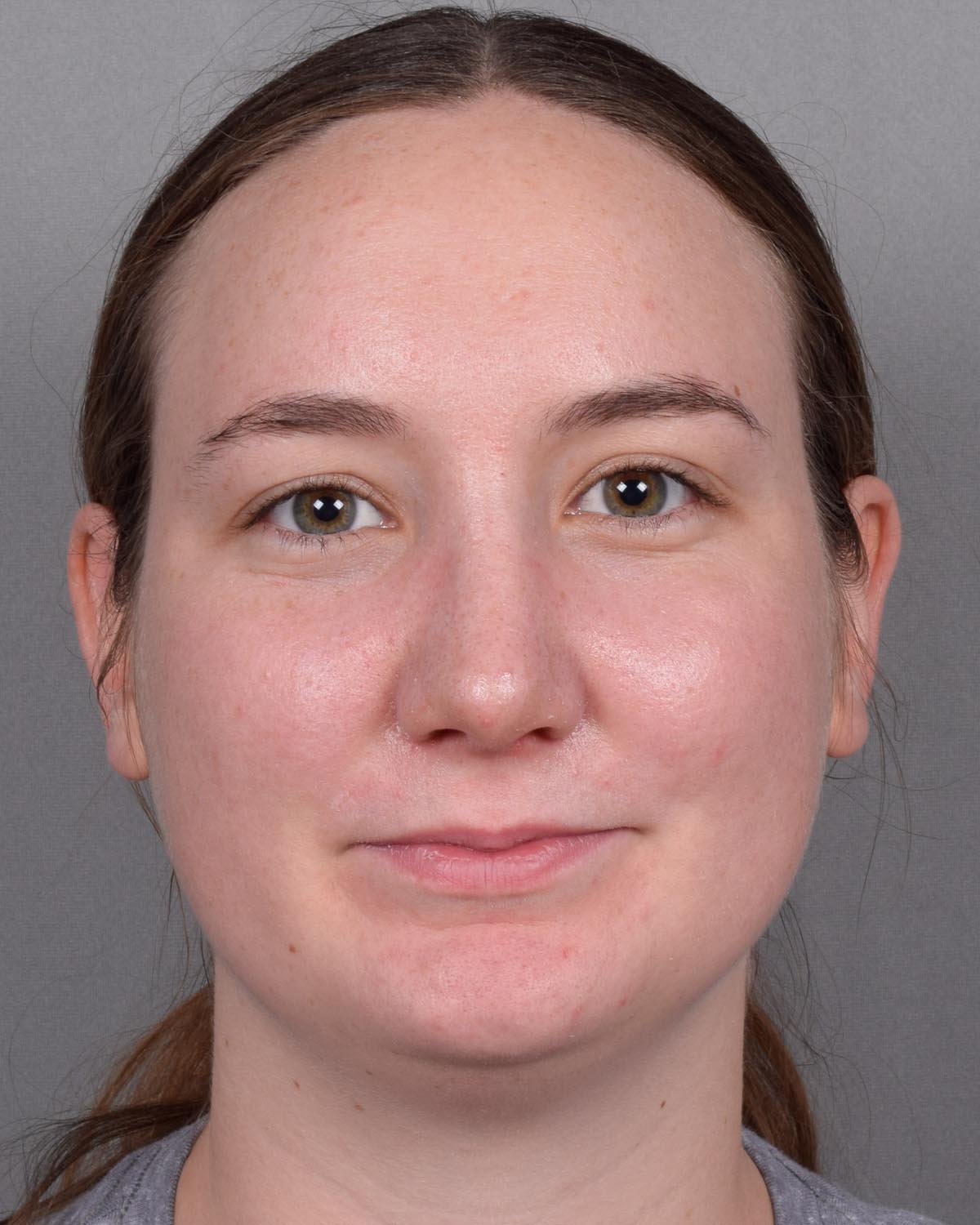 After Functional Rhinoplasty - Vegas Facial Plastics, Mehdi Sina, MD