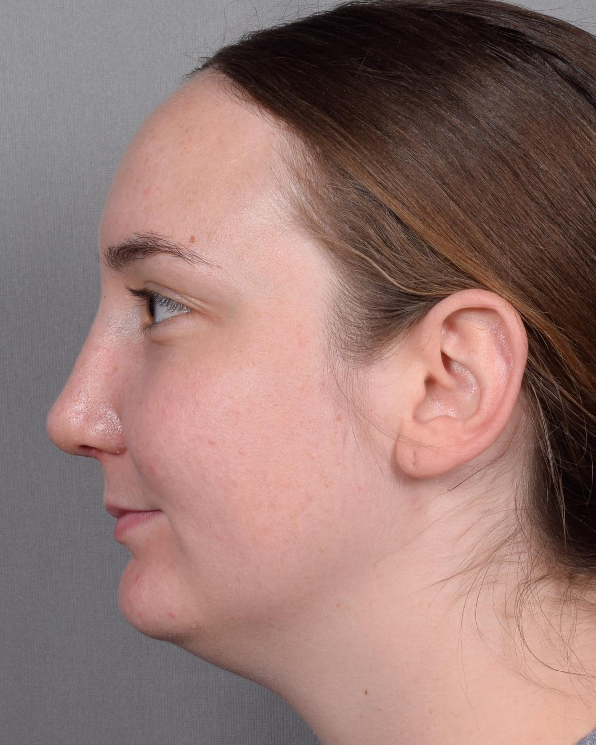 After Functional Rhinoplasty Profile - Vegas Facial Plastics, Mehdi Sina, MD