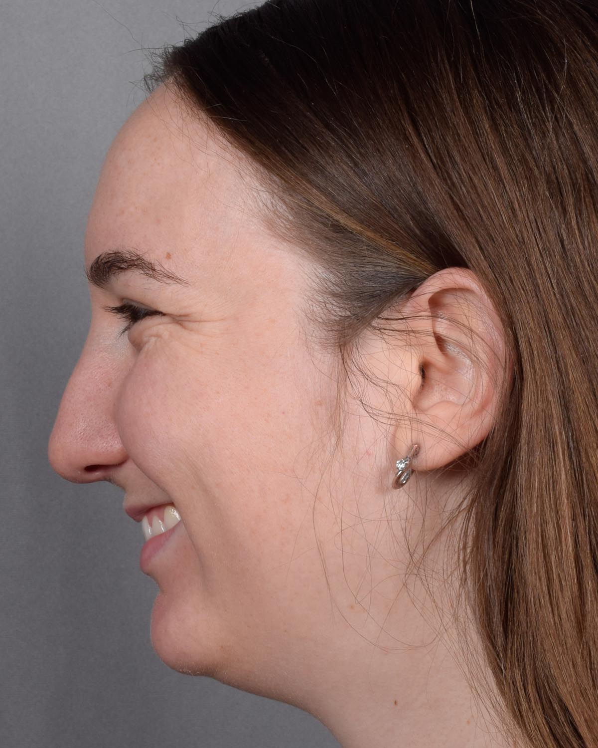 Before Functional Rhinoplasty Profile Smiling - Vegas Facial Plastics, Mehdi Sina, MD