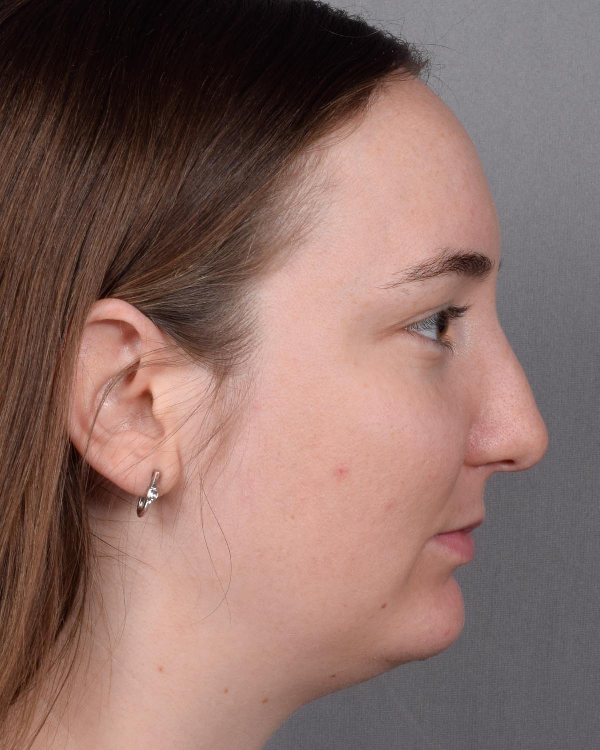 Before Functional Rhinoplasty Profile - Vegas Facial Plastics, Mehdi Sina, MD