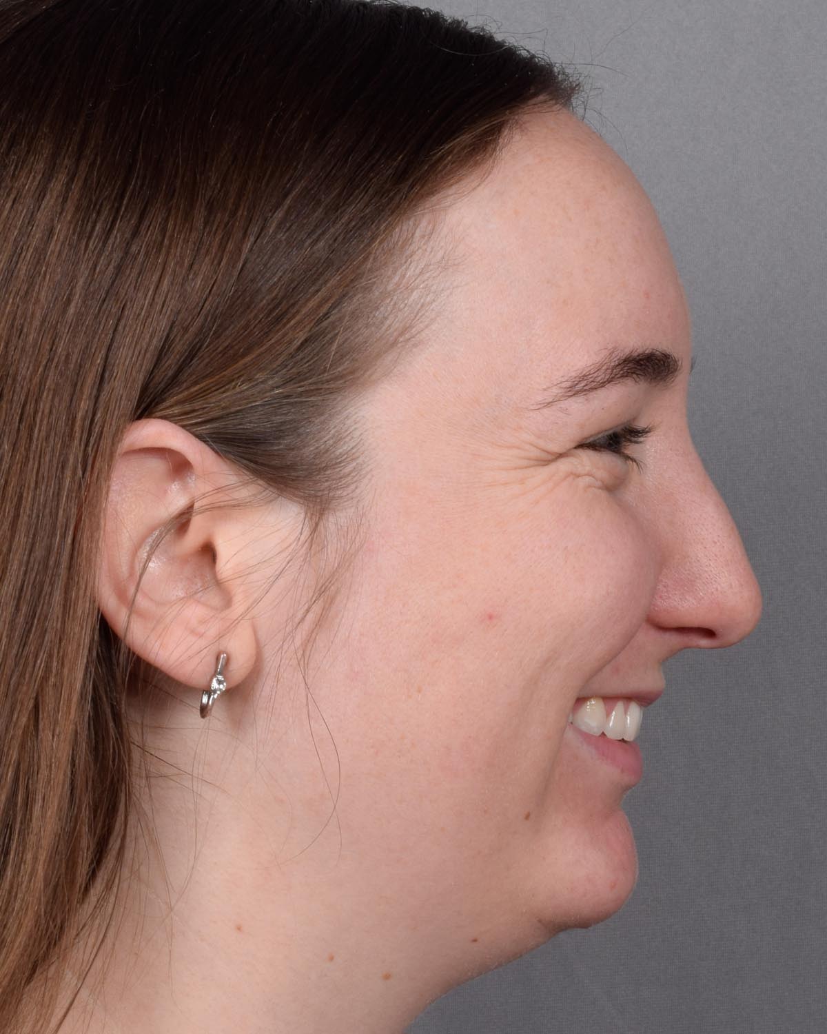 Before Functional Rhinoplasty Profile Smiling - Vegas Facial Plastics, Mehdi Sina, MD