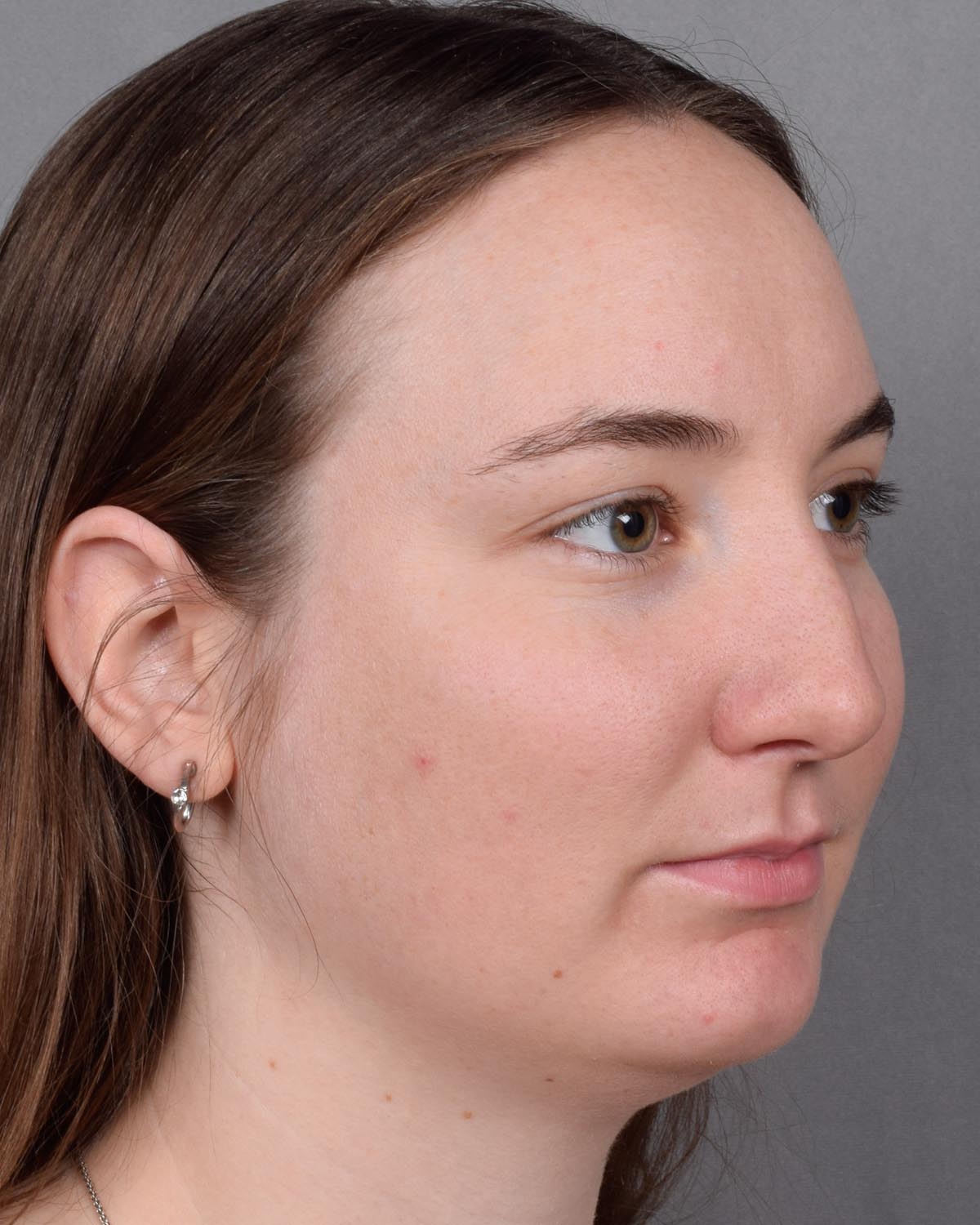 Case--8087 | Before Rhinoplasty 6