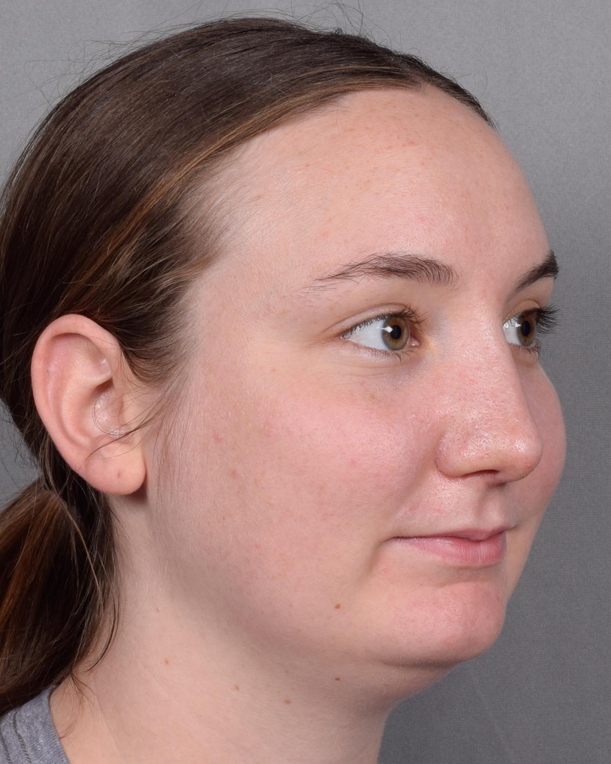 After Functional Rhinoplasty Oblique - Vegas Facial Plastics, Mehdi Sina, MD