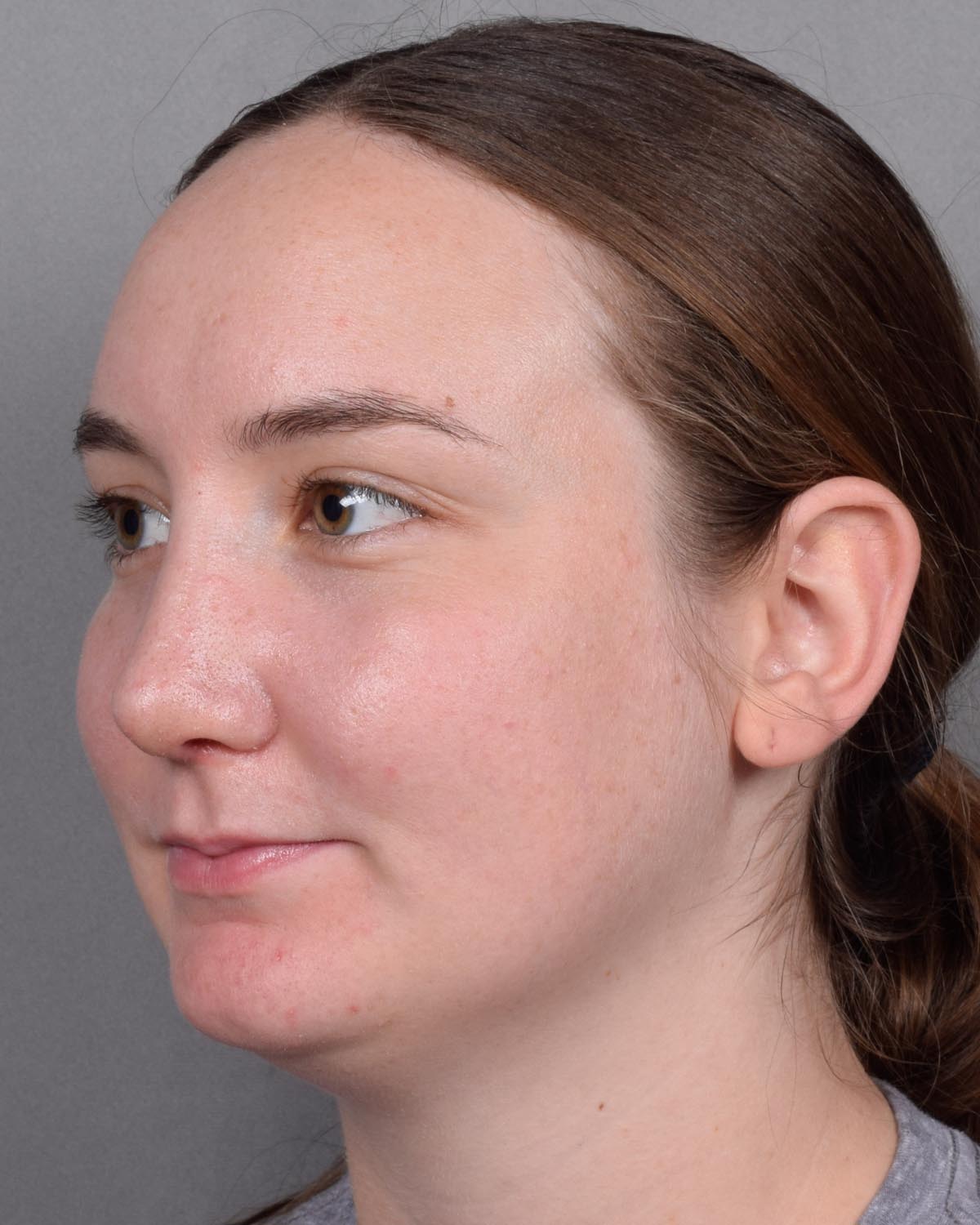 After Functional Rhinoplasty Oblique - Vegas Facial Plastics, Mehdi Sina, MD