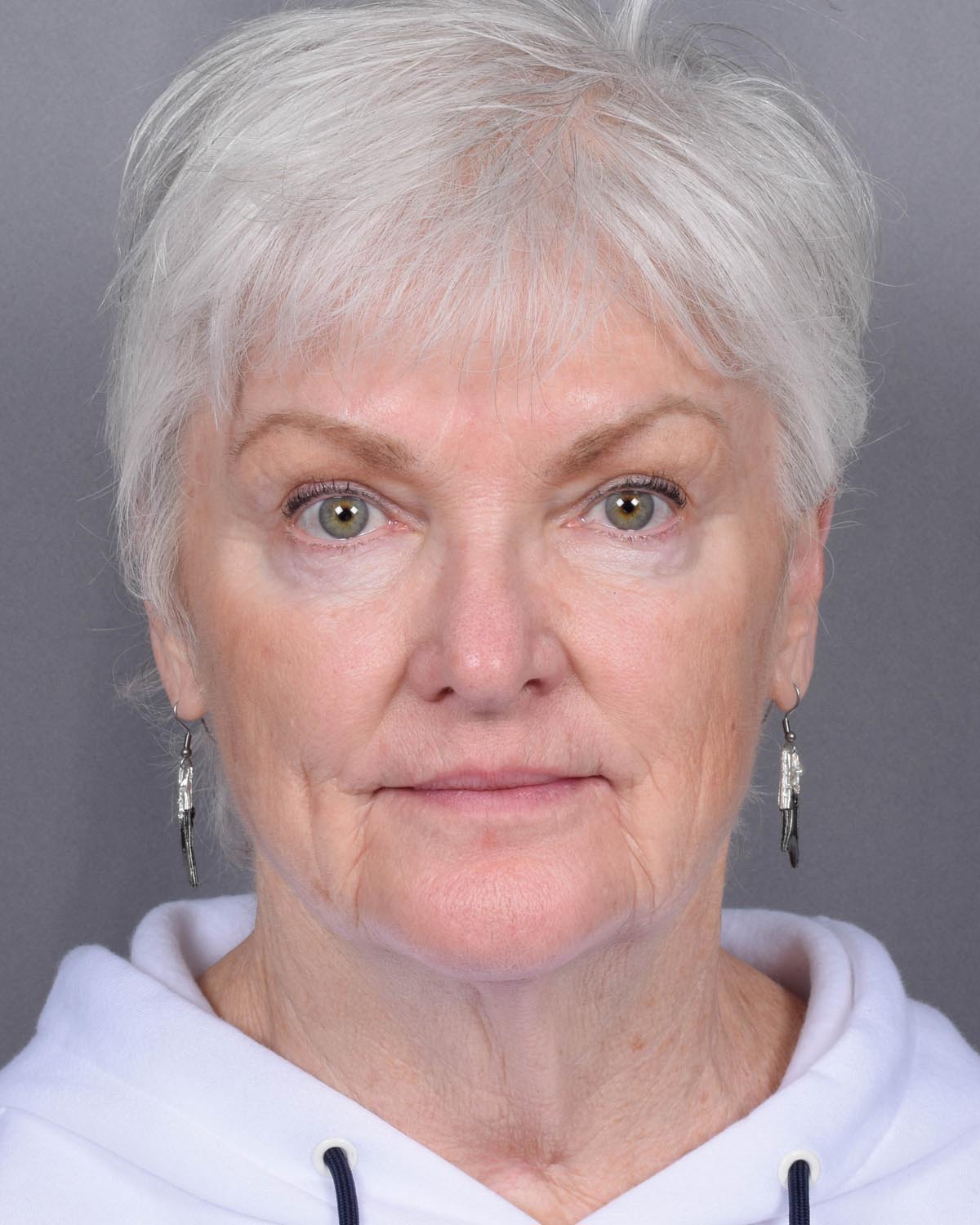 Before facelift and neck lift - Vegas Facial Plastics, Mehdi Sina, MD