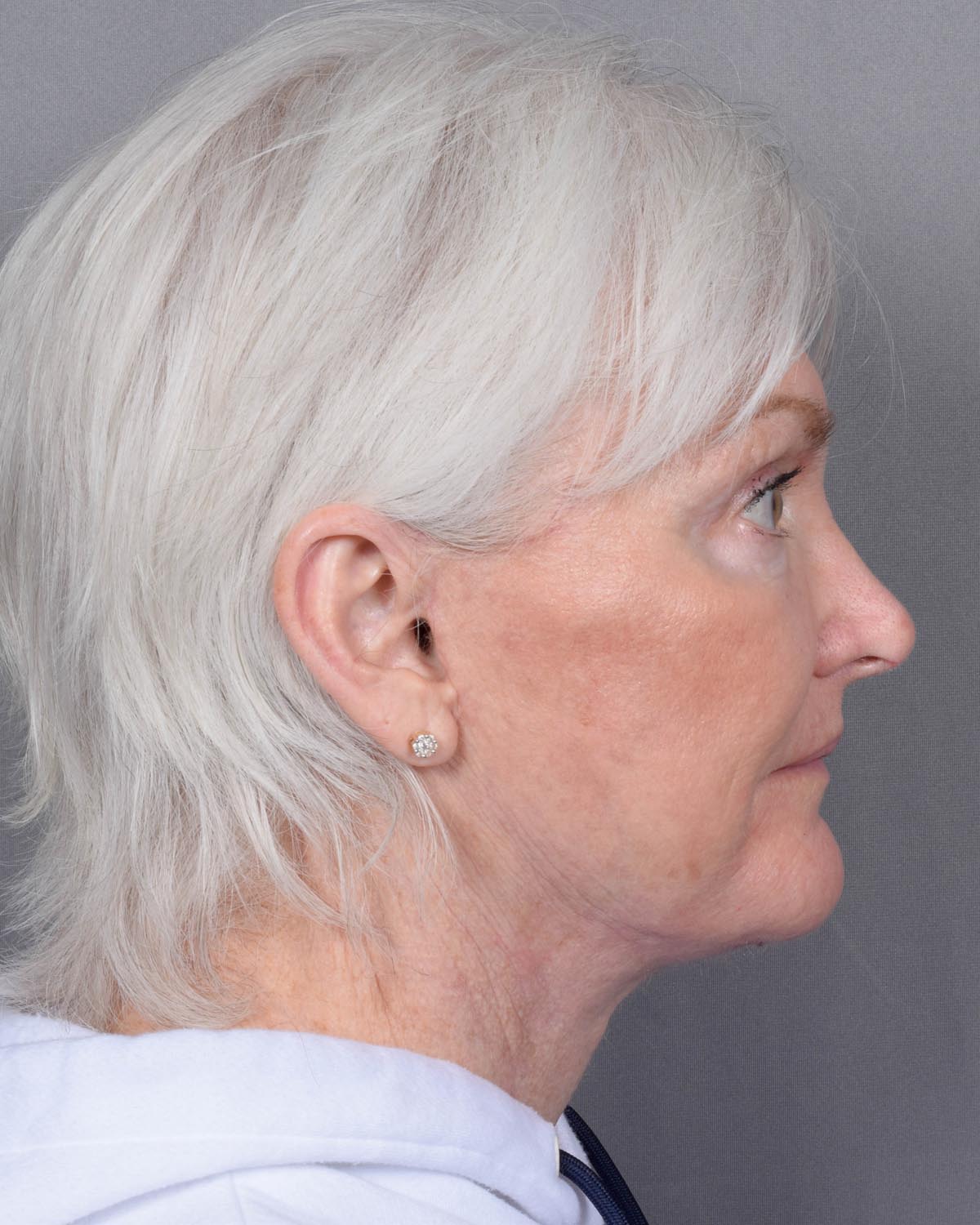 After facelift and neck lift Profile - Vegas Facial Plastics, Mehdi Sina, MD