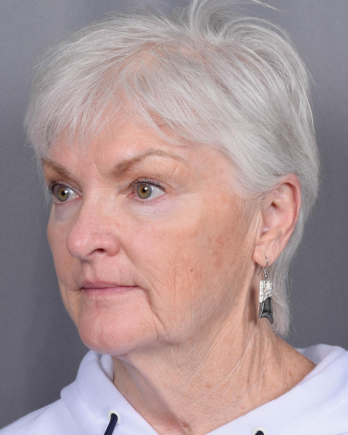 Before facelift and neck lift Oblique - Vegas Facial Plastics, Mehdi Sina, MD