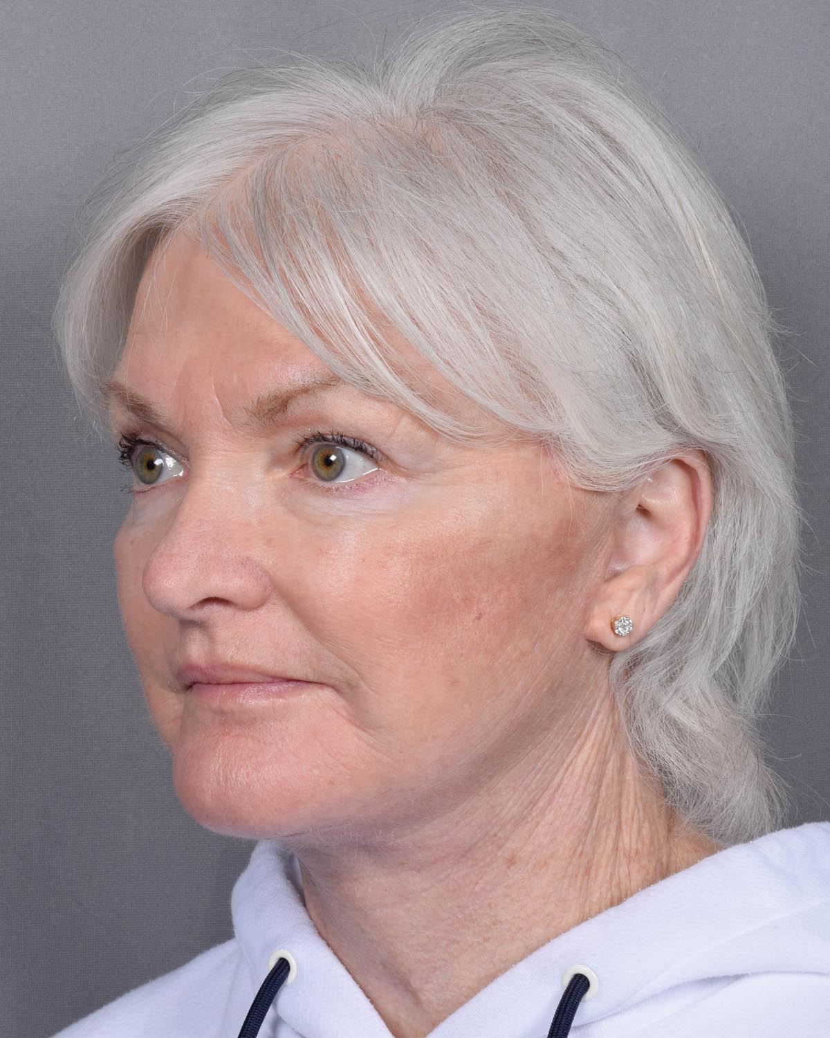 After facelift and neck lift Oblique - Vegas Facial Plastics, Mehdi Sina, MD