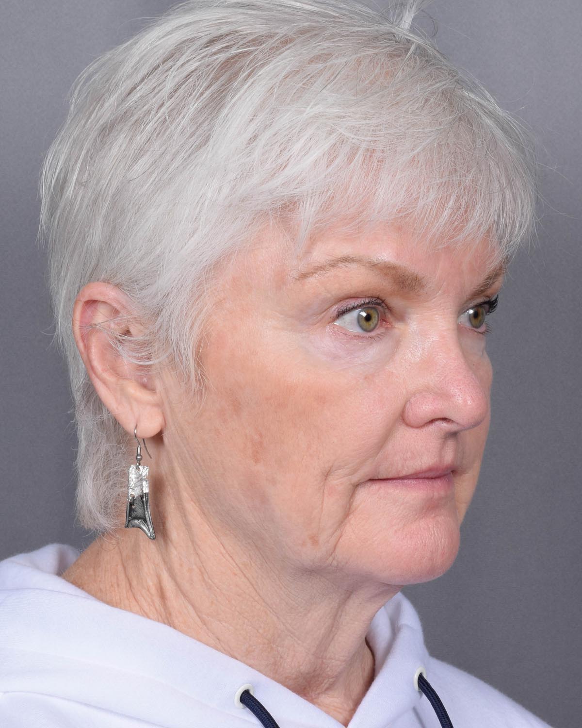 Before facelift and neck lift Oblique - Vegas Facial Plastics, Mehdi Sina, MD