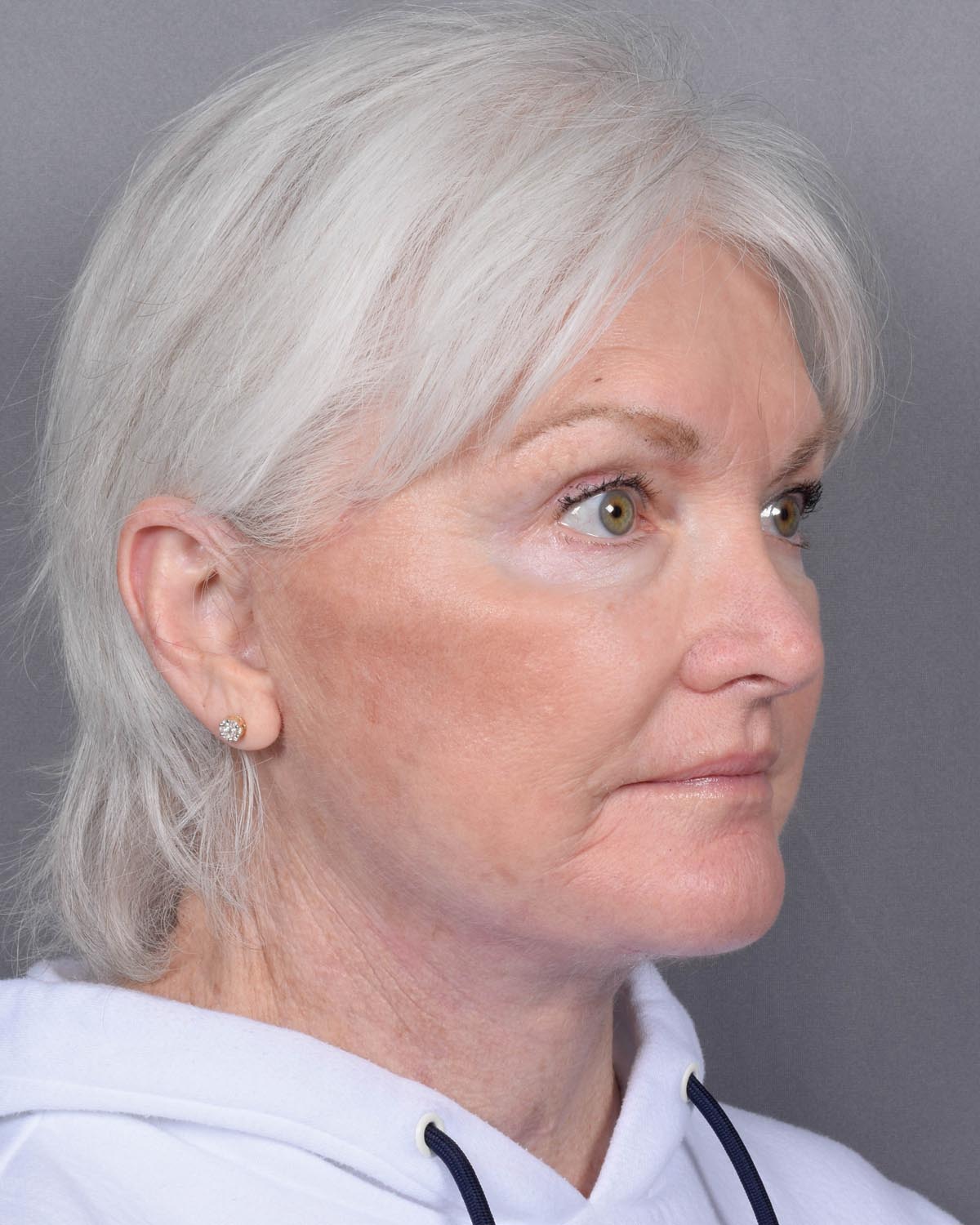 After facelift and neck lift Oblique - Vegas Facial Plastics, Mehdi Sina, MD
