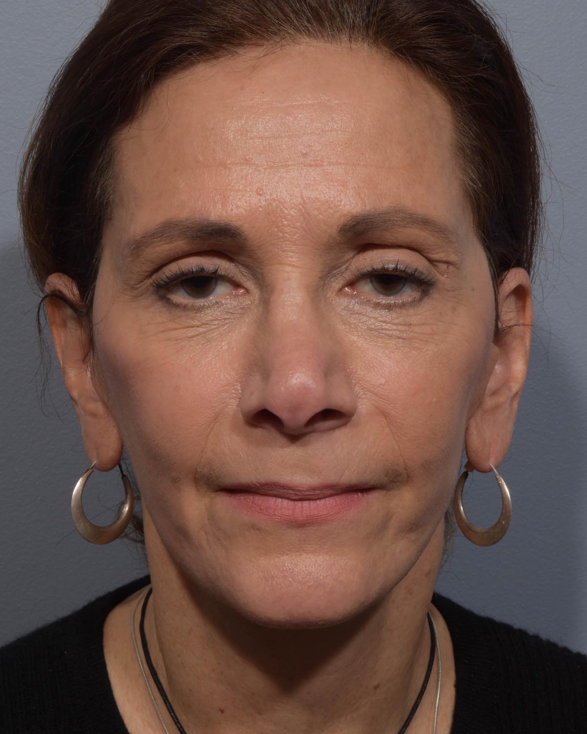 After Lower Blepharoplasty, facelift and neck lift, full face Laser resurfacing with CO2