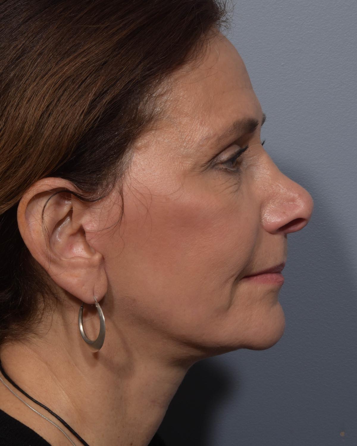 After Lower Blepharoplasty, facelift and neck lift, full face Laser resurfacing with CO2 Profile