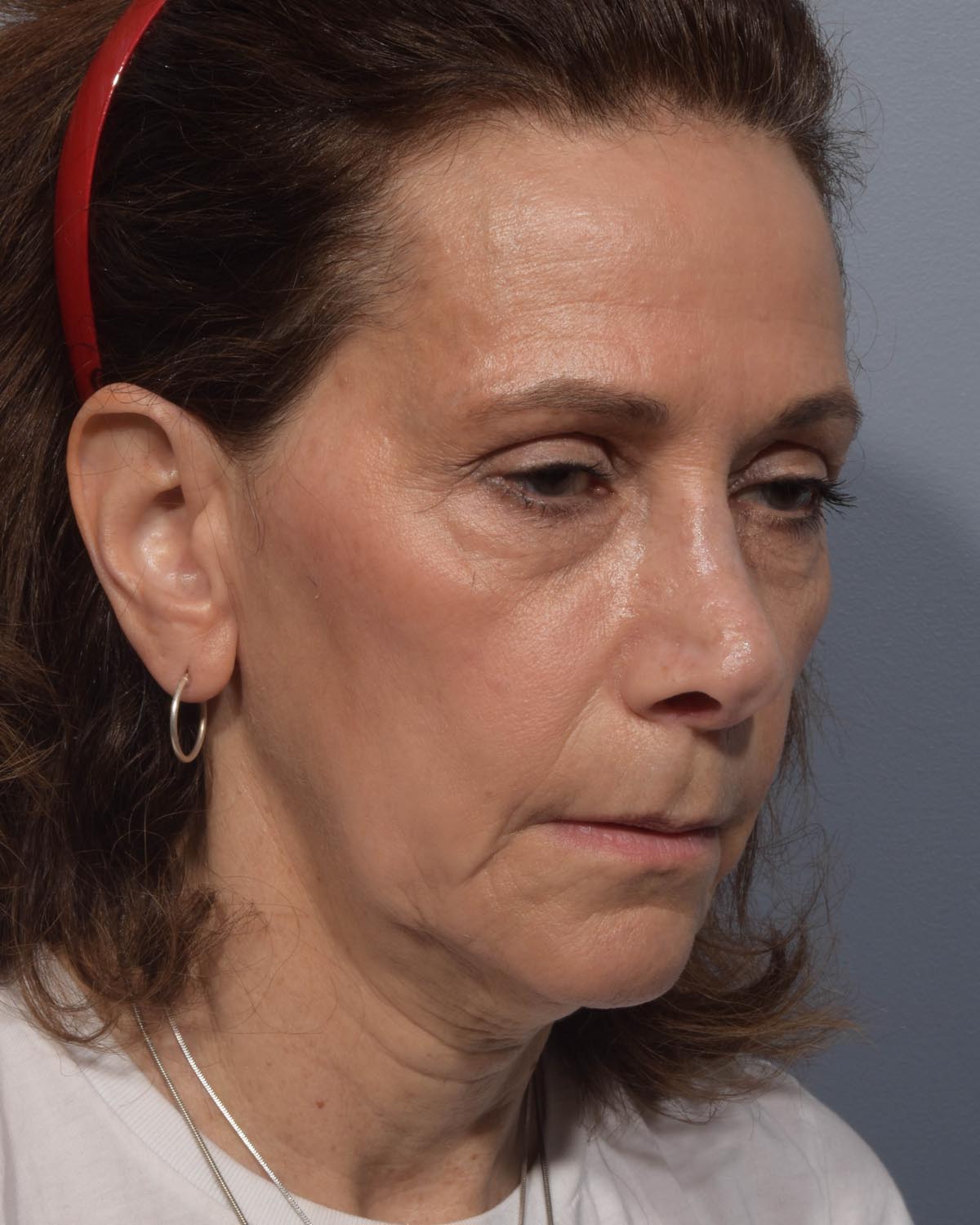 Before Lower Blepharoplasty, facelift and neck lift, full face Laser resurfacing with CO2 Oblique