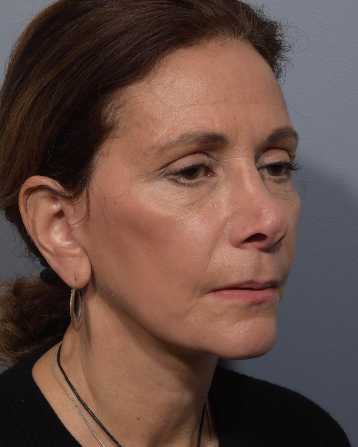 After Lower Blepharoplasty, facelift and neck lift, full face Laser resurfacing with CO2 Oblique