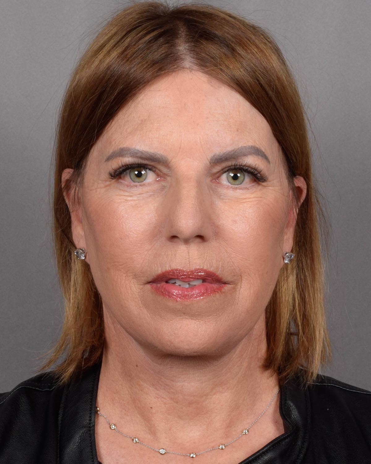 After Facelift - Vegas Facial Plastics, Mehdi Sina, MD