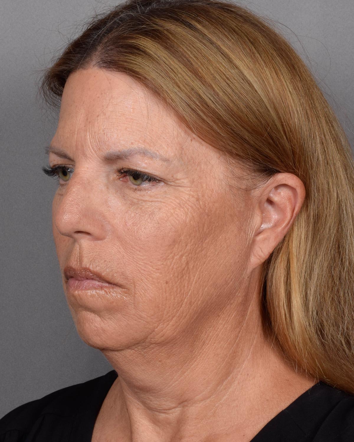 Before Facelift Oblique - Vegas Facial Plastics, Mehdi Sina, MD