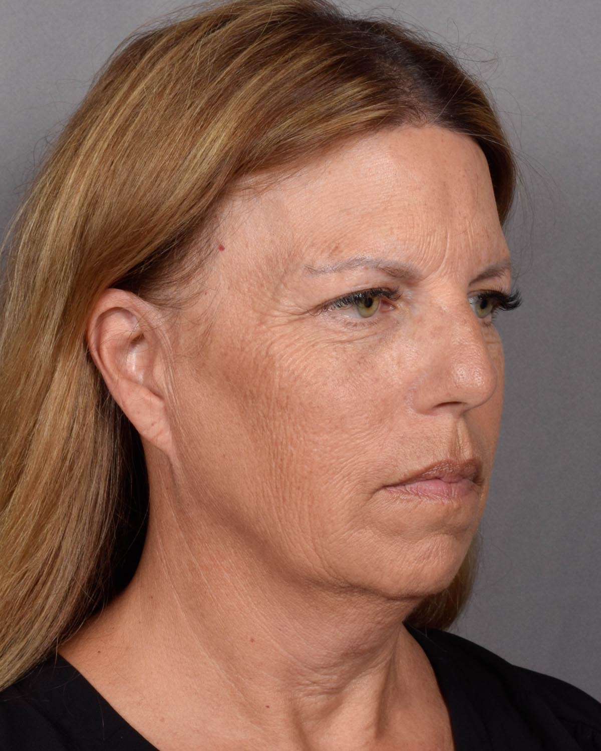 Before Facelift Oblique - Vegas Facial Plastics, Mehdi Sina, MD