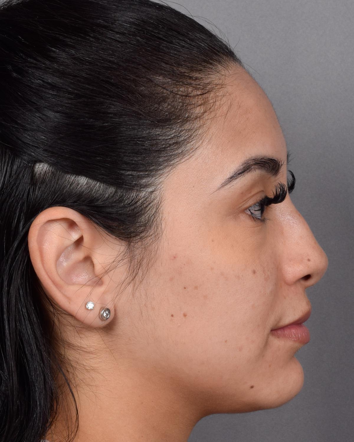 Before Revision and Functional Rhinoplasty Profile - Vegas Facial Plastics, Mehdi Sina, MD