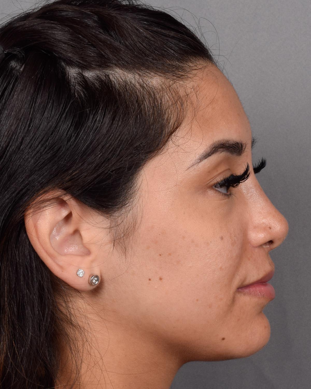After Revision and Functional Rhinoplasty Profile - Vegas Facial Plastics, Mehdi Sina, MD