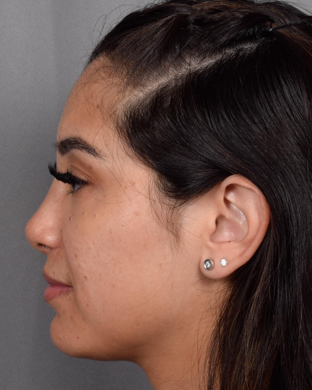 after Revision and Functional Rhinoplasty Profile - Vegas Facial Plastics, Mehdi Sina, MD