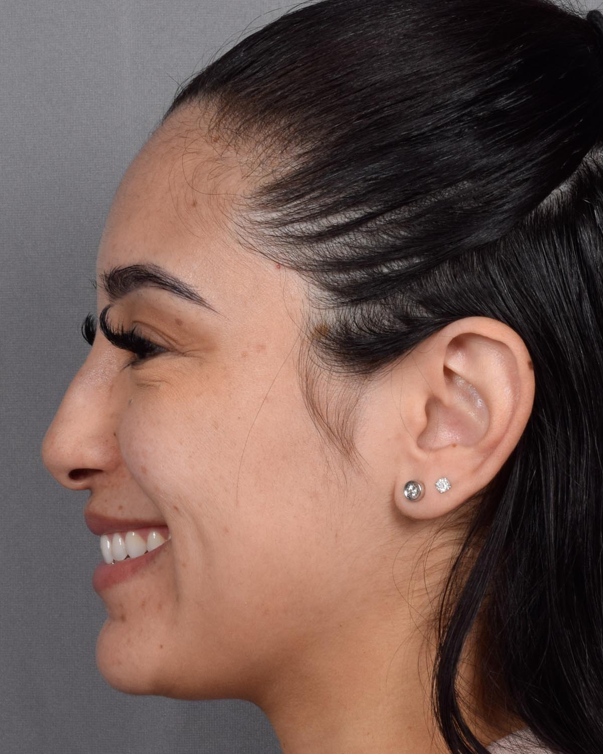 Before Revision and Functional Rhinoplasty Profile Smiling - Vegas Facial Plastics, Mehdi Sina, MD